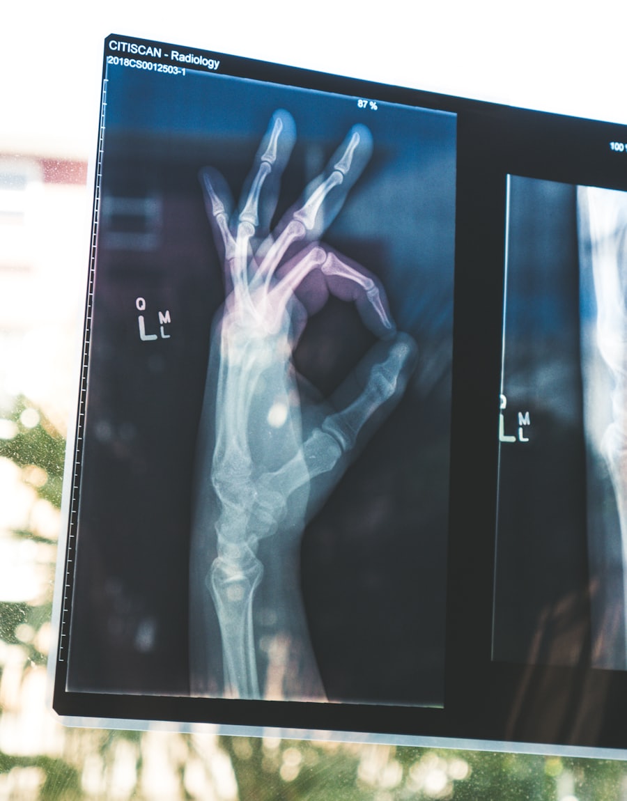 Digital orthopedic X-ray displayed on a modern radiology screen